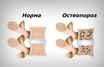 Остеопороз – «Безмолвная эпидемия». 