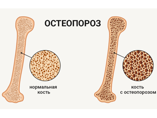 Всемирный день борьбы с остеопорозом