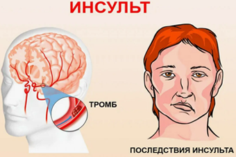 Инсульт